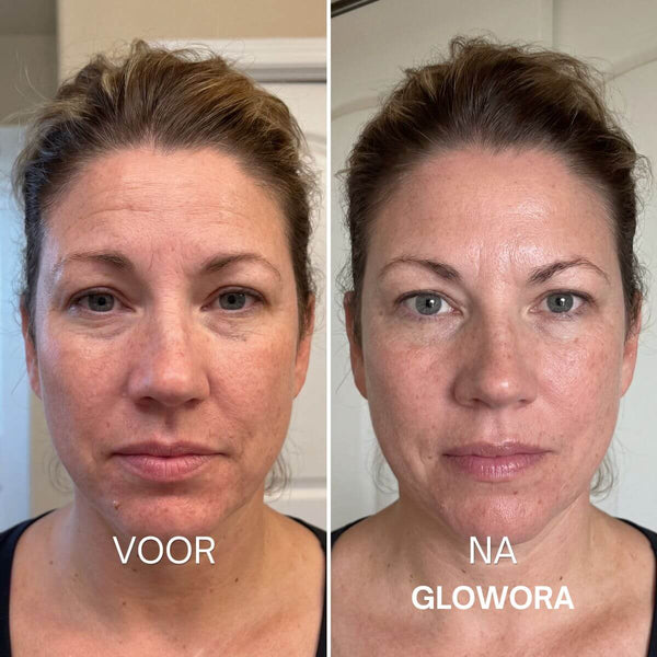 Falten unter den Augen